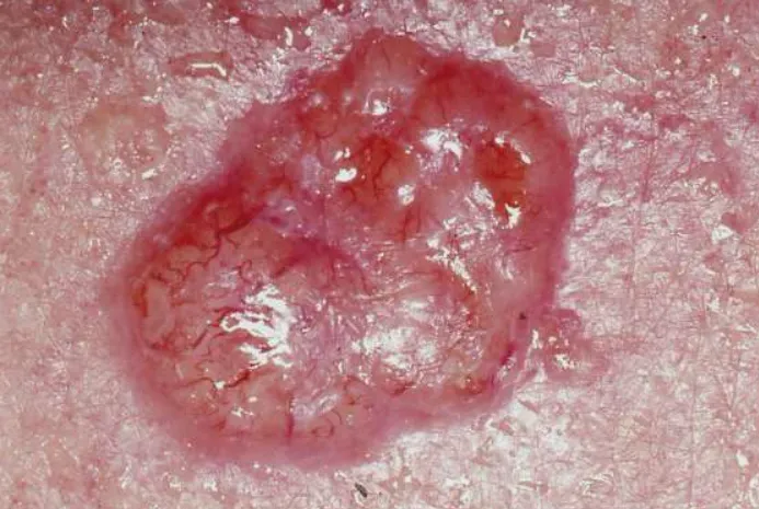 피부암 관련 이미지. 위키피디아