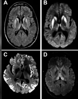 크로이츠펠트-야콥병 환자의 뇌 MRI 영상. Practical Neurology 캡처