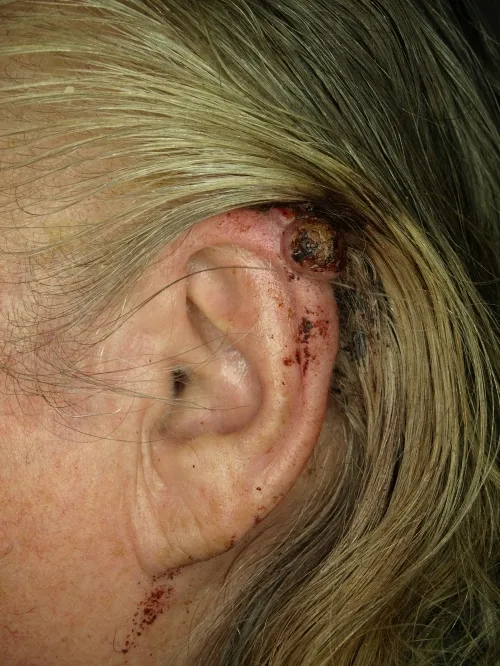 83세 여성 환자의 귀 흑색종 사례. 위키미디어 커먼스