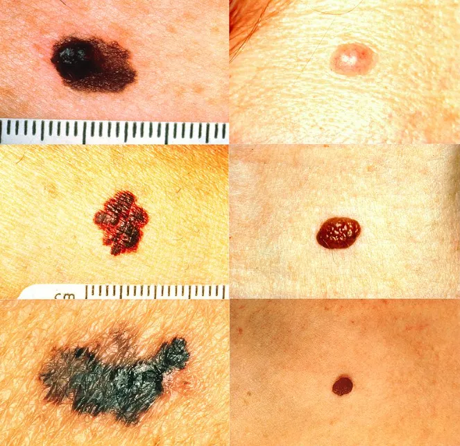 흑색종 관련 이미지. 위키피디아