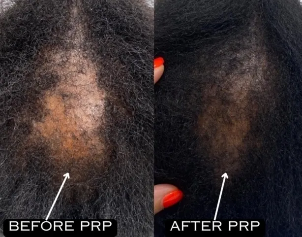 탈모 치료제 미녹시딜(Minoxidil)의 부적절한 사용으로 다모증이 발생한 여성의 사례가 보고됐다. American Journal of Case Reports