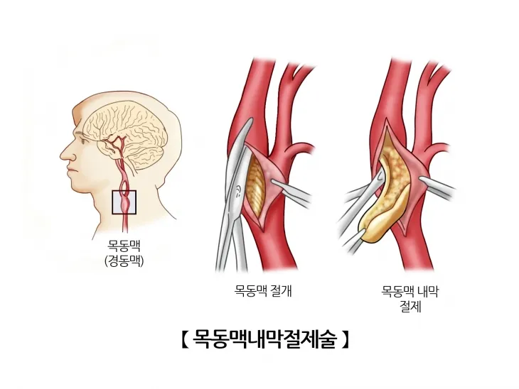 경동맥 내막 절제술 개요도. 자료 : 서울아산병원