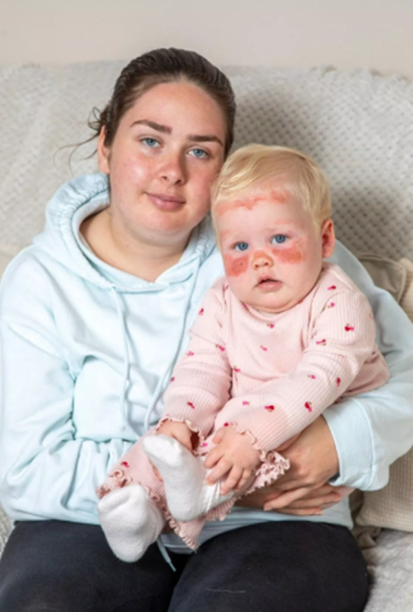 영국 스코틀랜드에서 유아 전용 자외선차단제를 바른 생후 12개월 아기가 야외 활동을 한 뒤 얼굴 전체에 심각한 화상을 입는 일이 발생해 충격을 주고 있다. 인스타그램 캡처