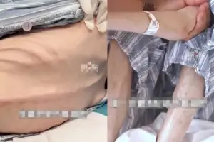“더 마르고 싶어”…다이어트약 150알씩 먹은 女, 25㎏ 되더니 결국 병원행