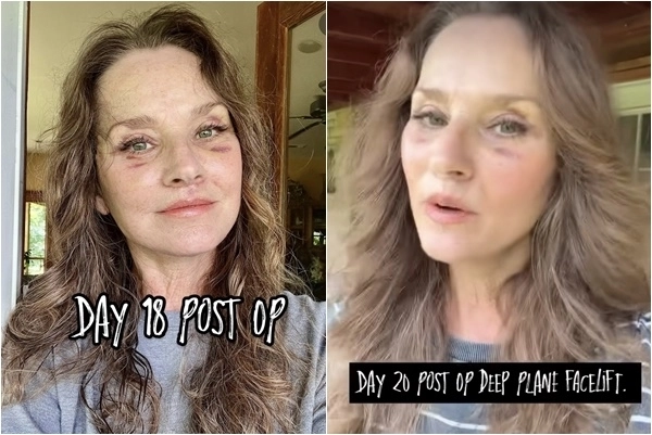 60대 미국 여성이 안면거상술 후기를 SNS에 공개했다. 인스타그램(@peggylynnmarchetti) 캡처