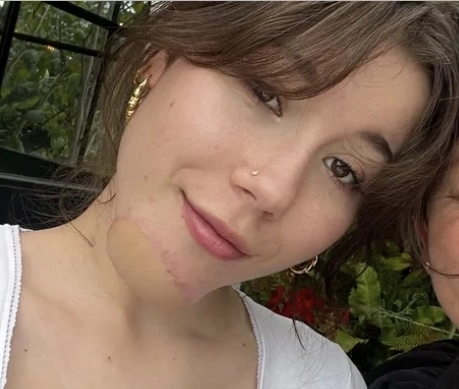 희귀 암 수술로 인해 턱 피부를 잃고 재건 수술을 받은 영국 여성이 턱에서 다리털이 난다고 호소했다. GoFundMe 페이지 캡처