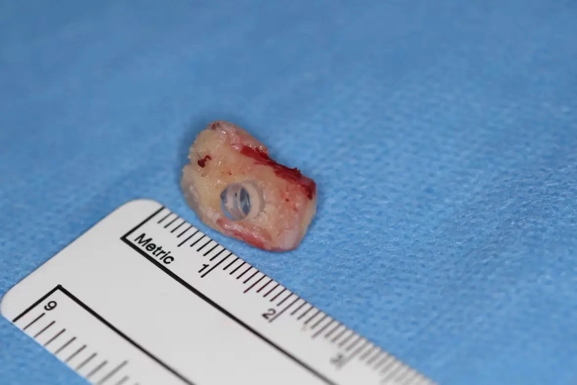 9일(현지시간) 캐나다 CBC뉴스에 따르면 10년 전 자가면역질환(스티븐스-존슨 증후군)으로 실명에 이른 게일 레인(75)은 지난 2월 송곳니를 갈아 만든 눈을 이식하고 시력을 갖게 됐다. 프로비던스 헬스케어 자료