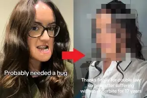 “9살 때부터 주걱턱” 놀림당하던 26세女 수술 후 ‘놀라운 변신’