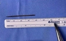 사우디아라비아에서 20대 남성이 수면 중 삼킨 이쑤시개로 인해 장이 천공되는 아찔한 상황을 겪었다. Journal of Surgical Case Reports