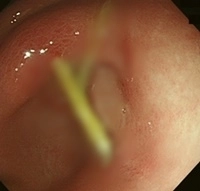 일본 28세 여성이 복통을 호소해 병원을 찾았다가, 위에 나무로 된 이쑤시개가 꽂혀있다는 사실을 알게됐다. 임상사례보고저널