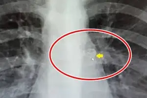 어금니 뽑다 실수로 삼키고 ‘콜록콜록’…가슴 속에 박혀있었다