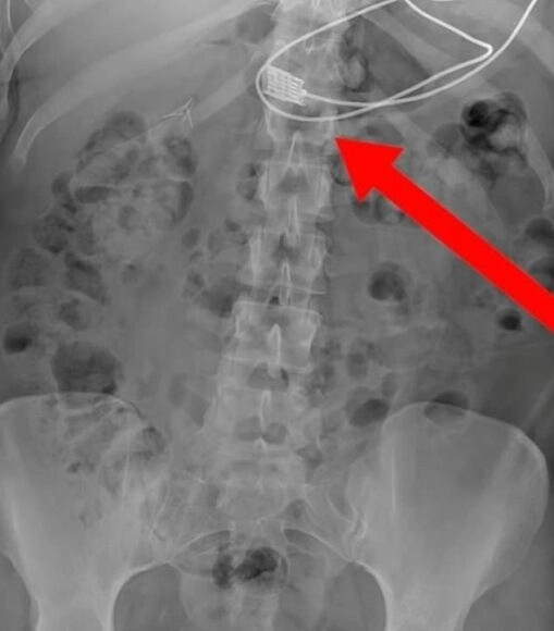 약 90㎝ 길이의 스마트폰 충전 케이블을 삼킨 이식증 환자의 엑스레이 사진. 자료 : 레디 투 레스큐