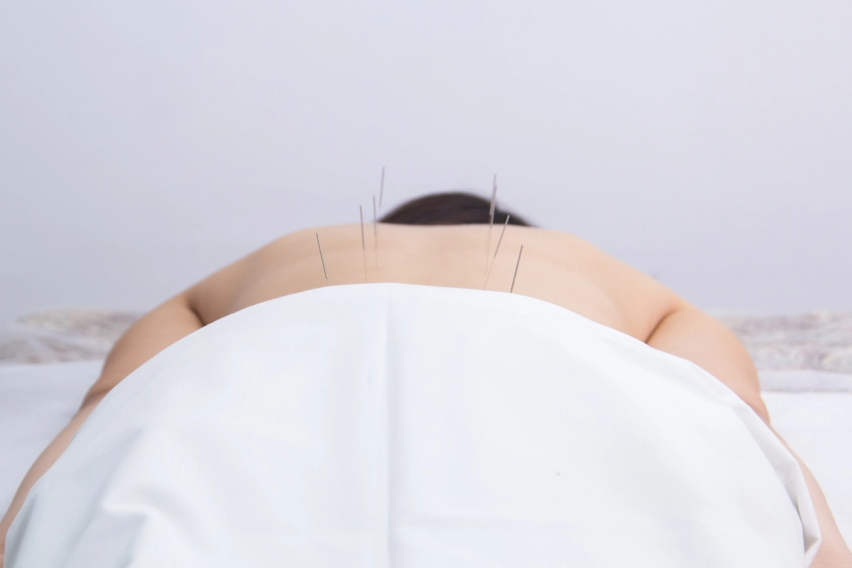 침술. 허리. 123rf