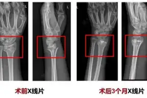 “부러진 뼈 3분만에 붙었다…혁신적 뼈 접착제 개발” 中연구팀 발표