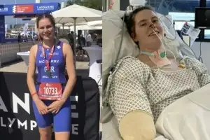 독감인 줄 알았는데 심정지 두 번…팔·다리 모두 절단한 英 대학생