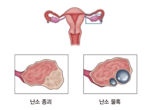 난소 낭종. 자료 : 서울아산병원