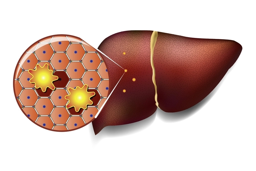 간 질환. 아이클릭아트