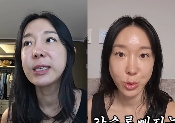 그룹 샵 출신 방송인 이지혜의 실 리프팅 시술 전후 모습. 유튜브 채널 ‘밉지 않은 관종언니’ 캡처