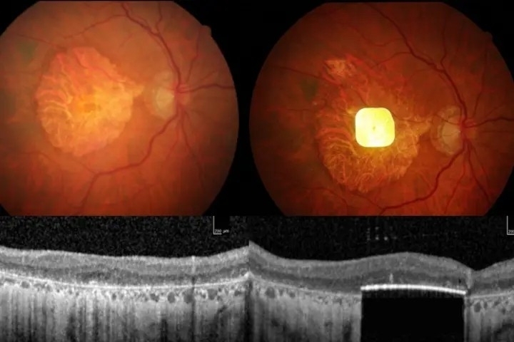 칩 삽입 전과 후. 무어필즈 안과병원 홈페이지 캡처.