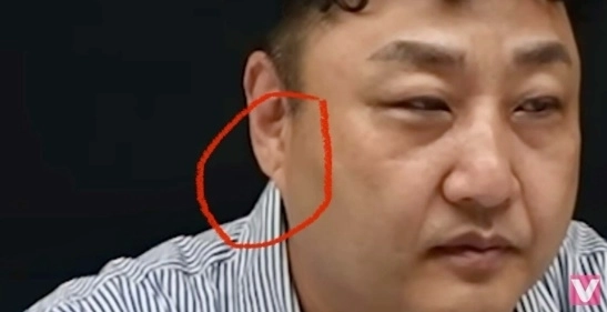 한 네티즌이 김수용의 귓볼에 프랭크 징후가 있었다고 주장했다. 유튜브 ‘비보티비’ 캡처