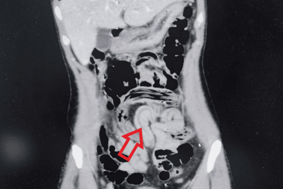 정맥 조영제를 이용한 복부 컴퓨터 단층촬영으로 소장과 대장 고리에서 공기로 채워진 선형적 공동 변화가 관찰됐다. 큐레우스