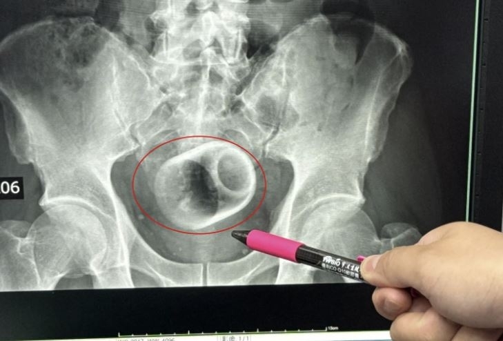 대만 타이중시 다자리 종합병원에서 X레이로 촬영한 남성 체내의 찻잔. 더 선 캡처