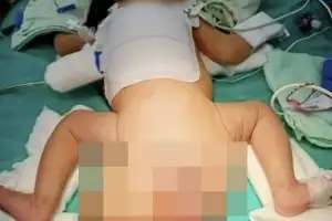 신생아 엉덩이에 탱탱볼 크기의 종양이…‘3만 5000분의 1 확률’이라는데