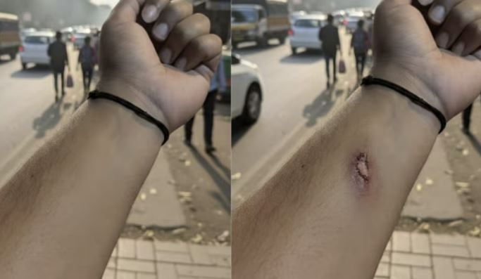 구글 인공지능(AI) 이미지 편집 도구인 나노바나나로 몇 초 만에 편집된 팔 부상 사진. 링크드인 캡처