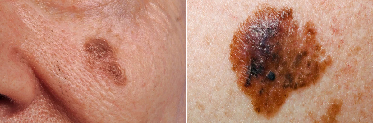 피부에 나타난 흑색종(Melanoma) 증상 사례. 일반적인 점과 달리 모양이나 가장자리가 고르지 않으며 2가지 이상의 색이 혼합돼 나타날 수 있다. 영국 국민보건서비스(NHS) 홈페이지 캡처