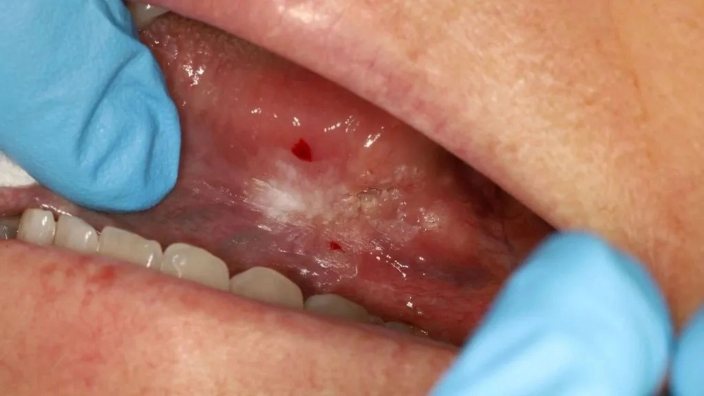 영국 여성이 입안에 생긴 궤양과 혀 통증을 일반적인 구내염 증상으로 대수롭지 않게 여겼다가 결국 ‘설암’이라는 충격적인 진단을 받고 투병 중이다. 여성의 입 안에 생긴 하얀 병변. BBC 캡처