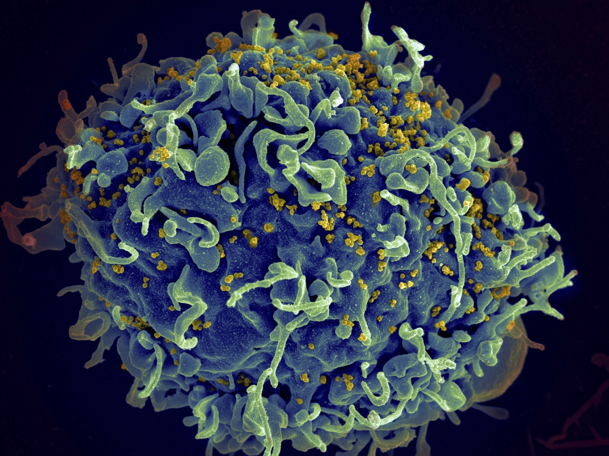 전자현미경으로 본 인체면역결핍바이러스(HIV, 노란색)의 인간 T세포(파란색) 공격 모습. AP 뉴시스 자료사진. 미국 국립보건원(NIH) 제공