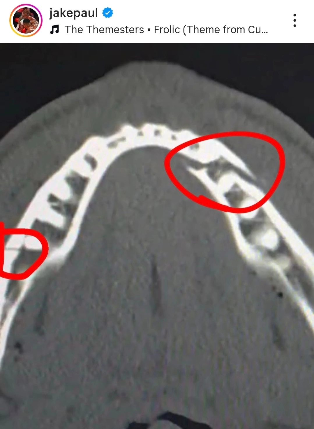 제이크 폴이 21일(한국시간) 자신의 인스타그램에 올린 턱뼈 부위 엑스레이 사진. 조슈아의 펀치에 턱뼈 두 곳이 부러졌다. 제이크 폴 인스타그램 캡처