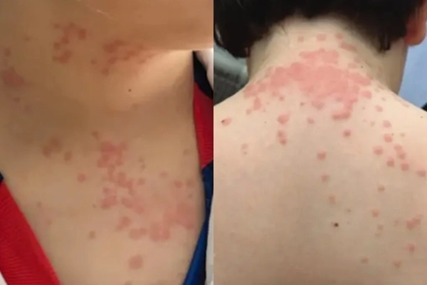 국제선 여객기에 탑승했던 미국의 한 가족이 기내에 들끓는 빈대에게 물려 큰 피해를 보았다며 항공사를 상대로 거액의 손해배상 청구 소송을 제기했다. 미국 버지니아 로어노크 서부 지구 연방 지방법원 제공