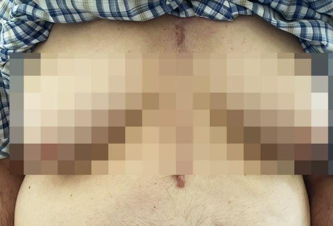 고혈압약 부작용으로 유방이 커진 76세 남성. 뉴잉글랜드의학저널