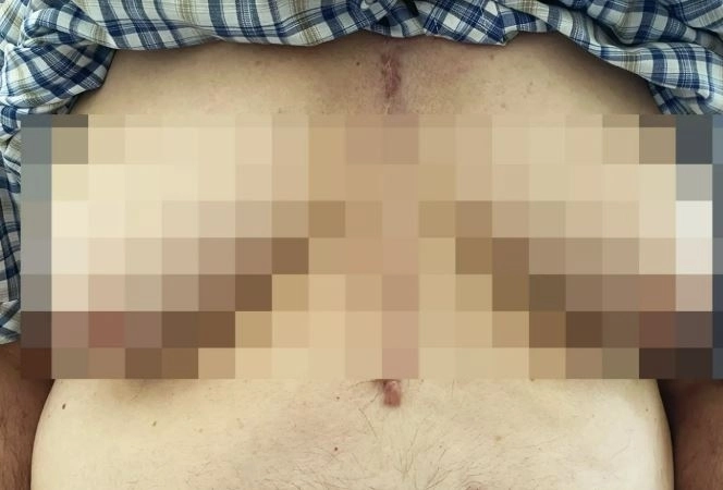 고혈압약 부작용으로 유방이 커진 76세 남성. 뉴잉글랜드의학저널