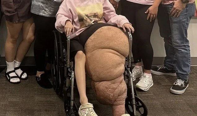 미국의 14세 소녀가 희귀 질환으로 인해 비정상적으로 커진 왼쪽 다리를 절단하는 대수술을 받은 사연이 전해졌다. ‘고펀드미’ 캡처