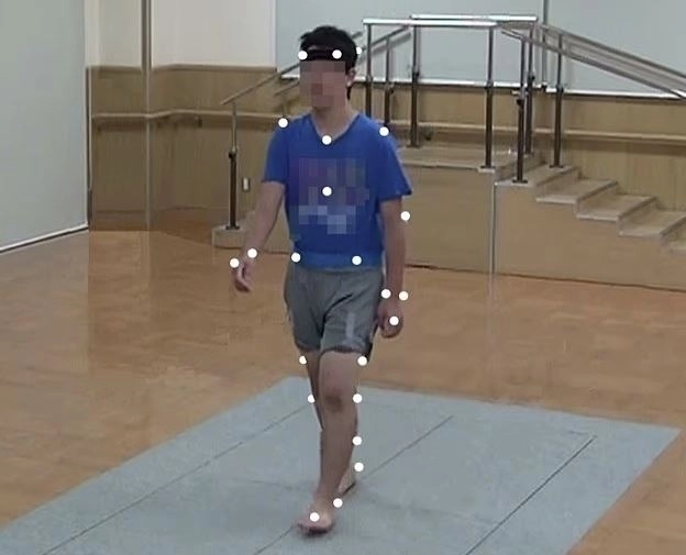 일본 연구는 ADHD 남아들에게서도 골반 기울기 현상을 발견했다. 자폐증과 ADHD는 동시에 나타나는 경우가 많다. 데일리메일 캡처