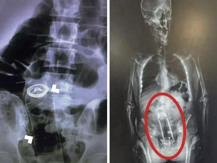 항문에 삽입한 데오드란트 캔으로 응급 수술을 받은 이란 남성 사례(왼쪽)와 항문에 보온병을 넣은 채 체포된 플로리다 남성의 신체 스캔 이미지(오른쪽). 응급의학저널·폴크카운티 보안관 사무소