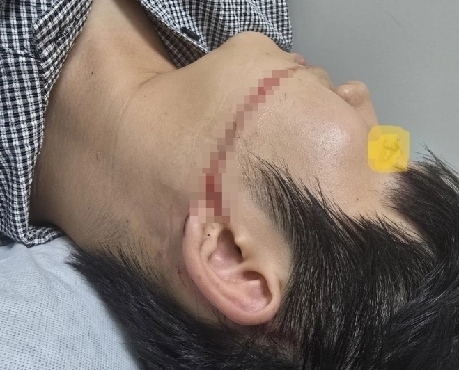 안산시 물축제에서 워터건에 맞아 다친 대학생 A씨. 연합뉴스