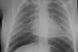 위장이 풍선처럼 부풀다 ‘펑’…‘이 술’ 인기에 의사들 경고 나왔다