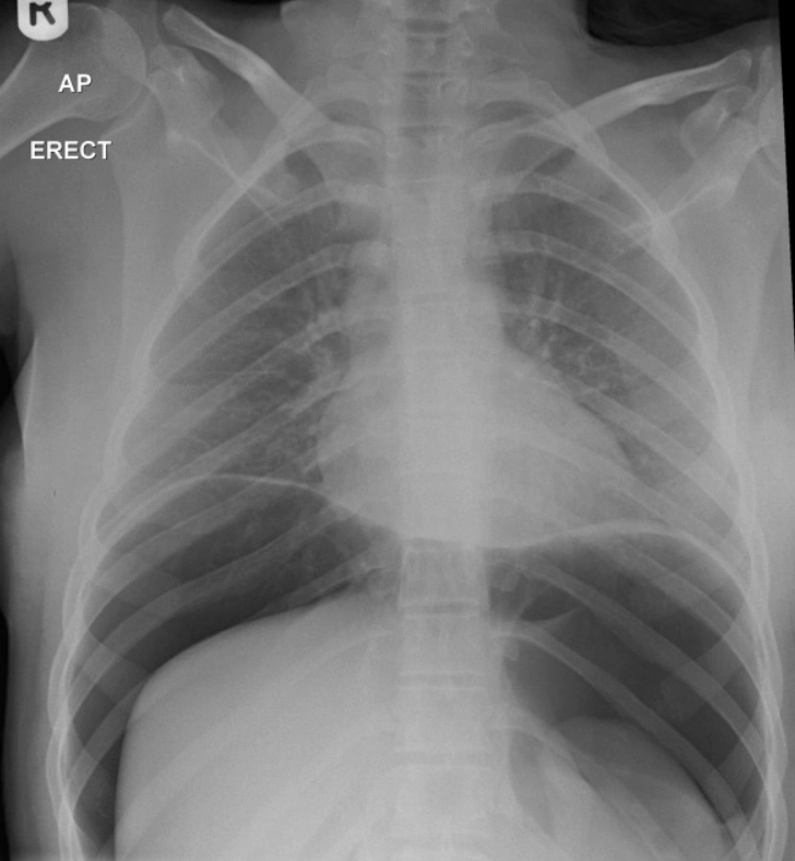 바(Bar)나 레스토랑에서 시각적 효과를 위해 널리 쓰이는 ‘액체질소 칵테일’이 자칫 위장을 파열시킬 수 있다는 경고가 나와 눈길을 끌고 있다. 연구 자료