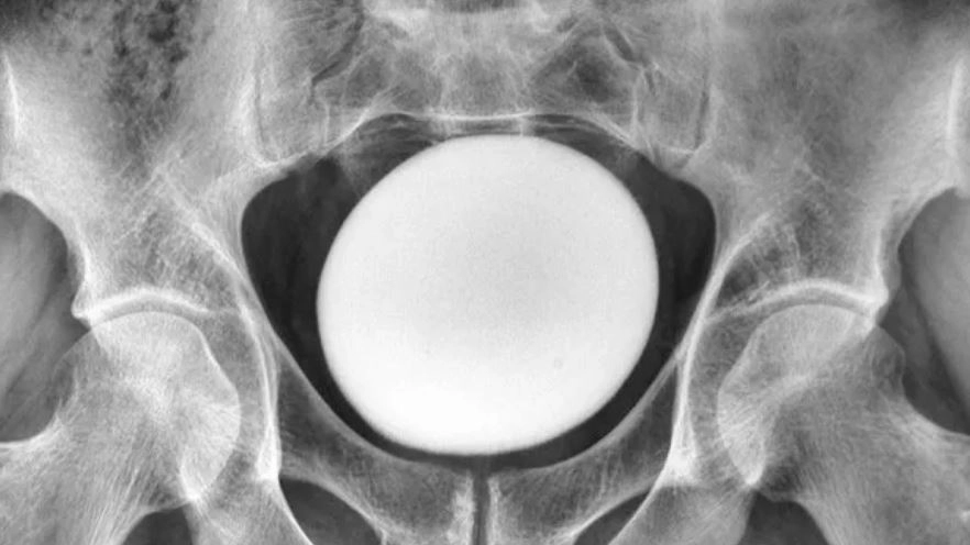 이란 35세 남성의 방광에서 발견된 타조알 크기의 결석. 라이브사이언스 캡처