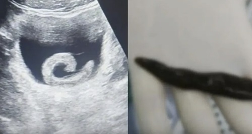 중국의 한 20대 남성의 방광에서 살아 있는 거머리가 발견돼 의료진이 긴급 제거에 나섰다. 바이두 캡처