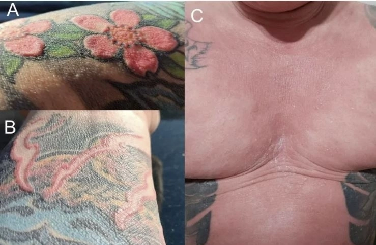 팔뚝의 빨간색 문신 부위에 피부 손상이 나타난 초기 단계(왼쪽 위·아래)와 이후 온몸이 붉게 부어오르고 모든 털이 빠진 모습(오른쪽). 의학 학술지 클리닉스 앤 프랙티스