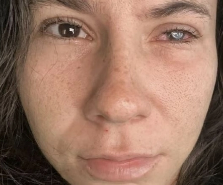 기생충의 일종인 가시아메바에 감염돼 한쪽 시력을 잃은 비비안 노소비츠키(21). 인스타그램 캡처