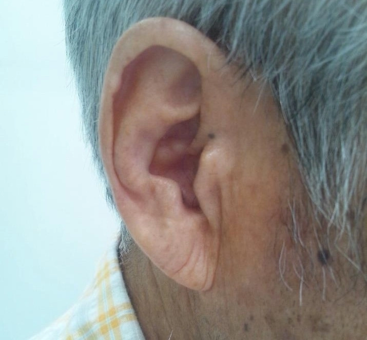 일본인 협심증 환자에게서 관찰된 귓불 주름. 위키피디아