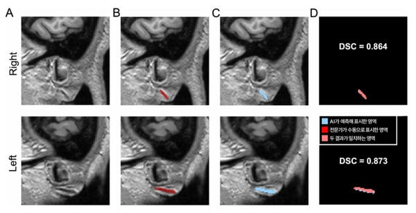 3차원 원본 이미지(A)를 토대로 전문가가 수동으로 직접 표시한 주름(B)과 AI가 예측해 자동으로 표시한 영역(C). DSC 값은 두 영역의 겹침 정도를 수치화한 것으로, AI가 전문가와 거의 일치하게(약 87%) 주름을 찾아냈다는 의미를 가진다. 분당서울대병원 제공