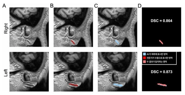 3차원 원본 이미지(A)를 토대로 전문가가 수동으로 직접 표시한 주름(B)과 AI가 예측해 자동으로 표시한 영역(C). DSC 값은 두 영역의 겹침 정도를 수치화한 것으로, AI가 전문가와 거의 일치하게(약 87%) 주름을 찾아냈다는 의미를 가진다. 분당서울대병원 제공
