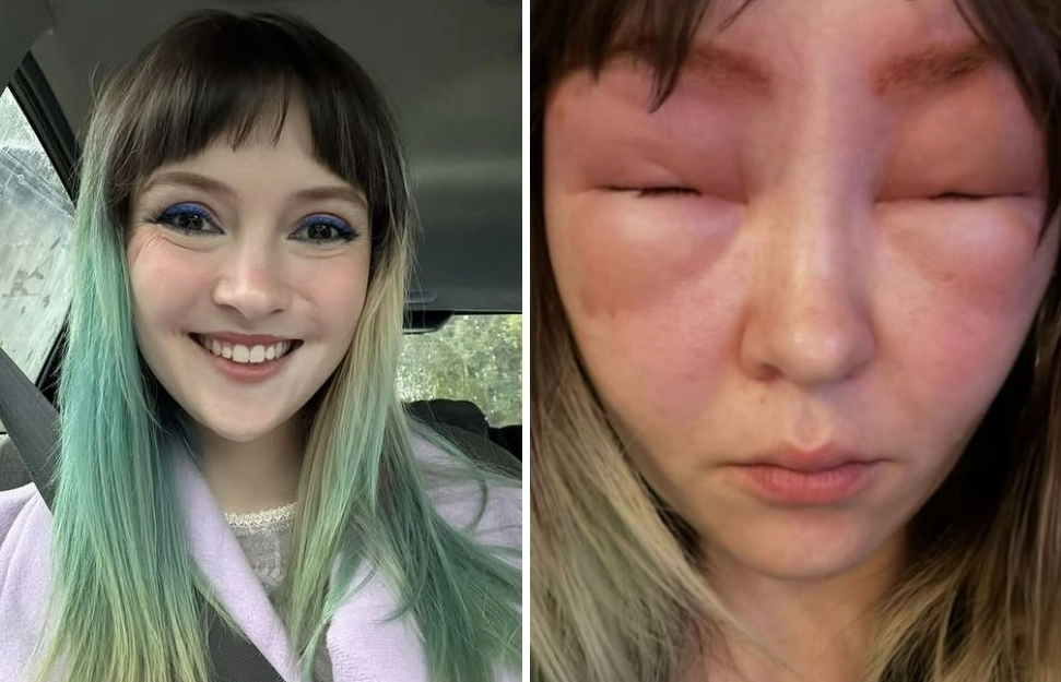 캐나다 밴쿠버에 사는 켈시 클리브(32)의 눈썹 염색 전 정상적인 모습(왼쪽)과 염색 후 심하게 부어오른 모습. 인스타그램(@kelseycleave) 캡처