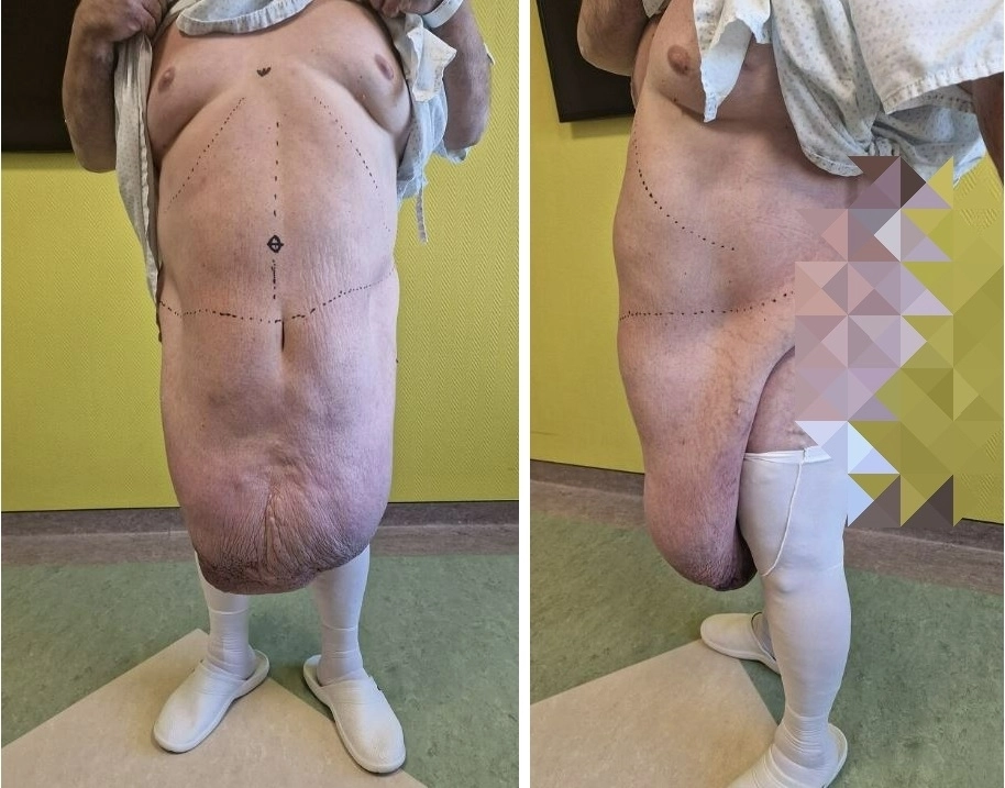 복부에 늘어진 종양 35kg을 제거하는 수술을 받은 북마케도니아의 54세 남성. 외과 사례 보고 저널 캡처